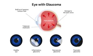 What are the Types of Glaucoma?