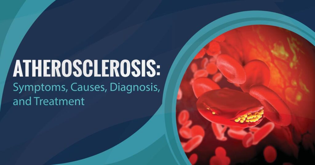 Atherosclerosis: Symptoms, Causes, Diagnosis, and Treatment