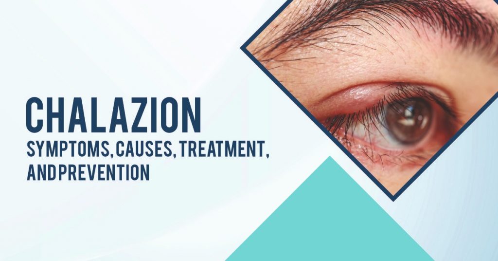 Chalazion Symptoms, Causes, Treatment, and Prevention