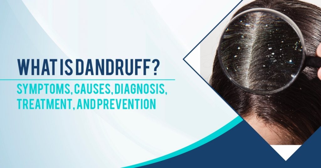 What is Dandruff? Symptoms, Causes, Diagnosis, Treatment, and Prevention