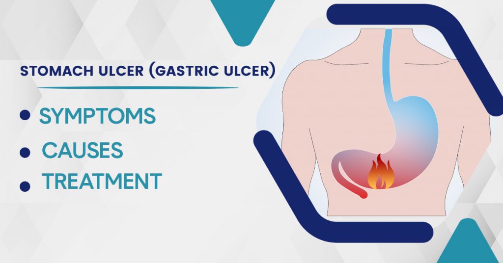 Stomach Ulcer (Gastric Ulcer): Symptoms, Causes, and Treatment - GPSH ...