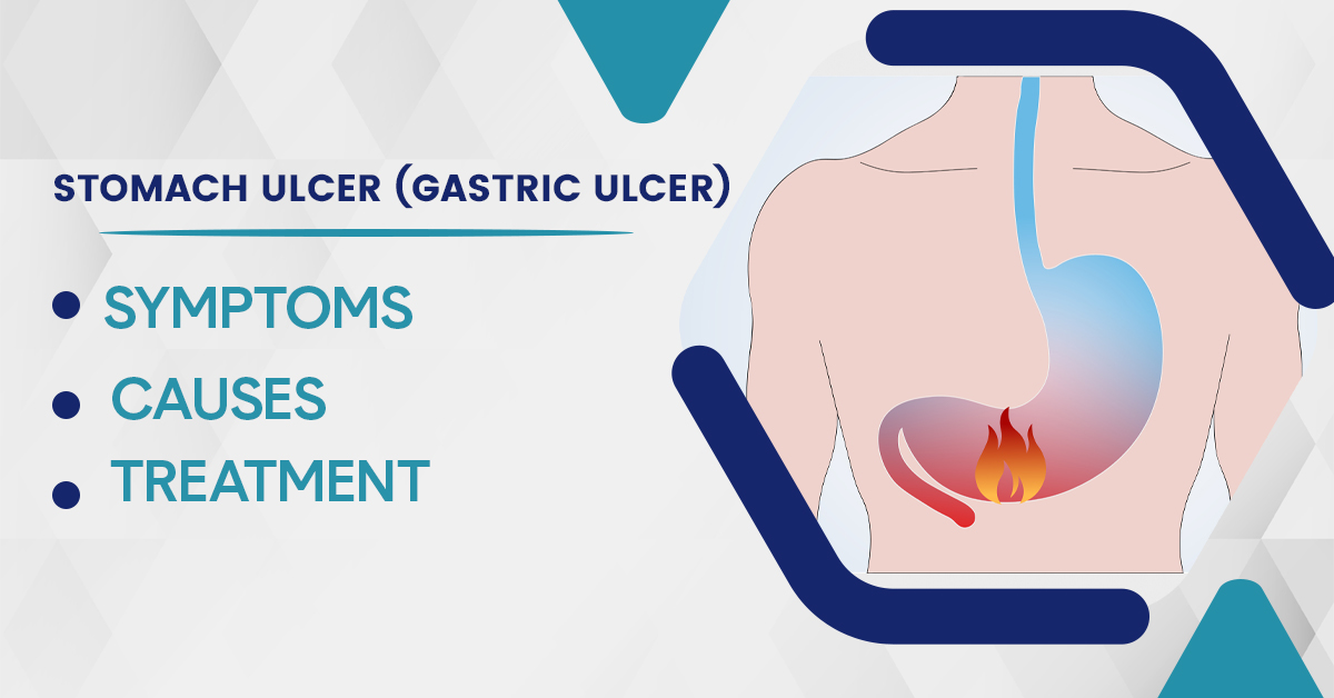 Stomach Ulcer (Gastric Ulcer): Symptoms, Causes, and Treatment