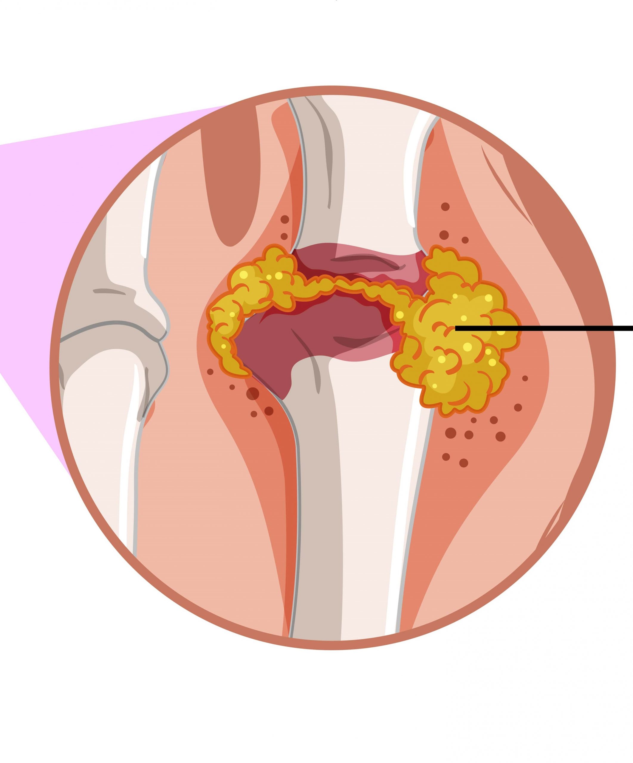 orthopedic Hospital in jaipur | Joint Aspiration