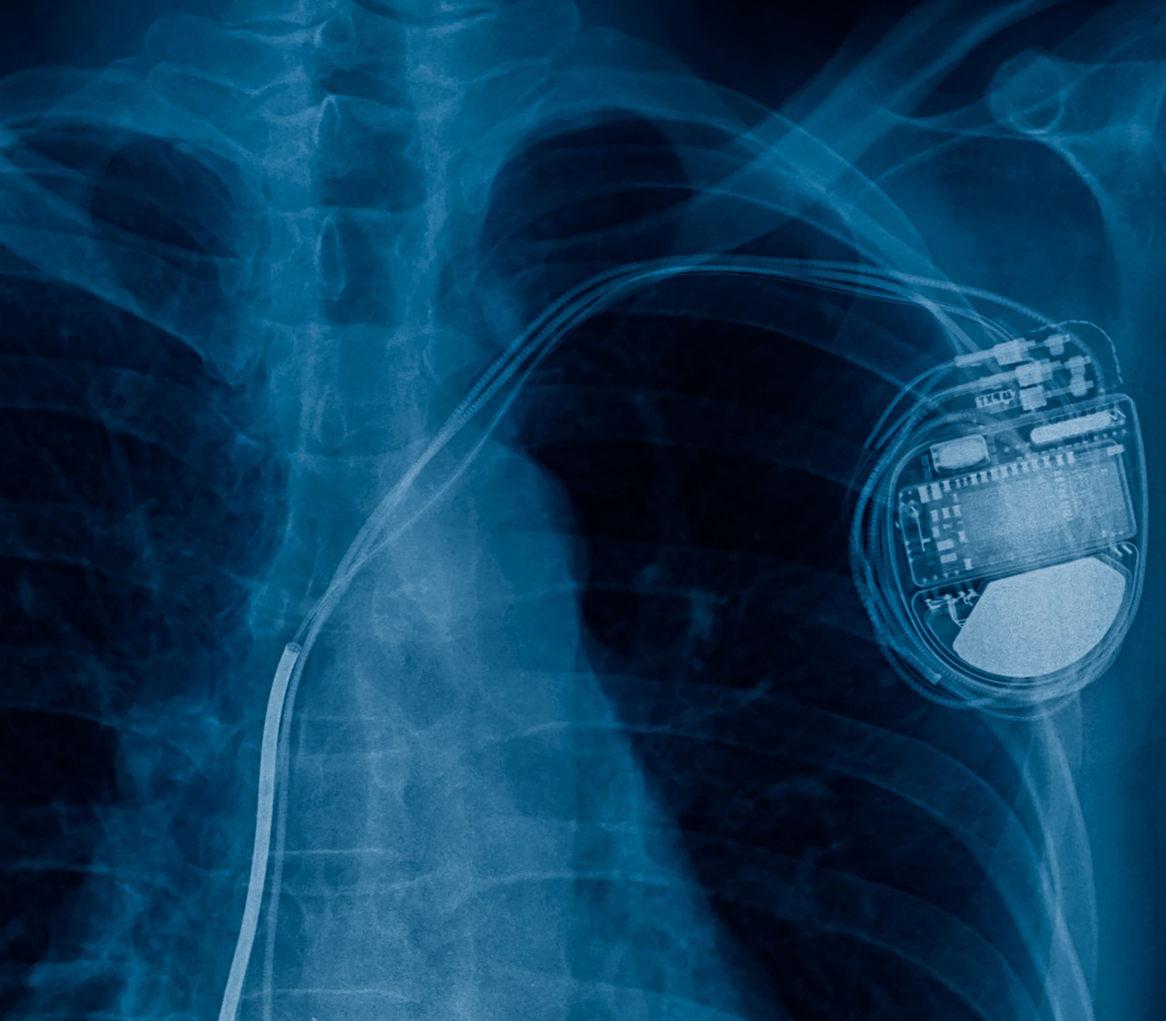 Pacemaker implantation | cardiology hospital