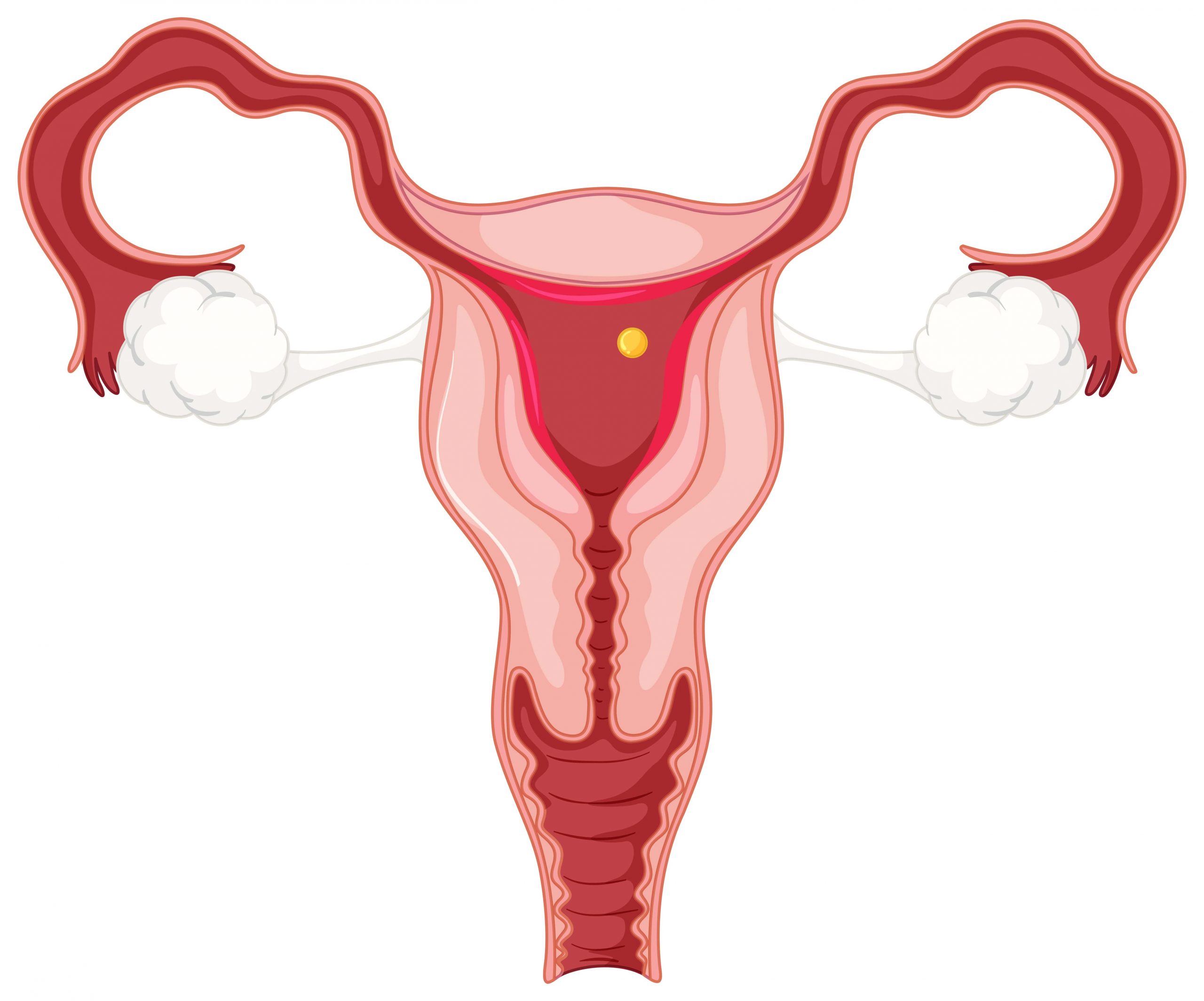 hysterectomy