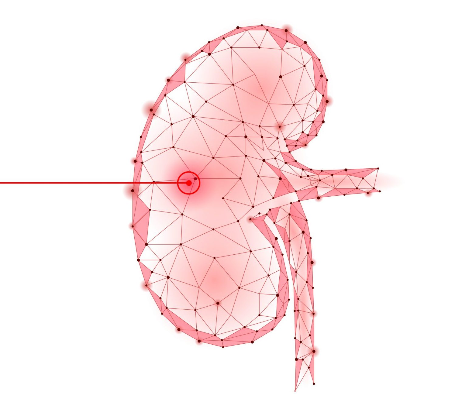 Human kidneys laser surgery