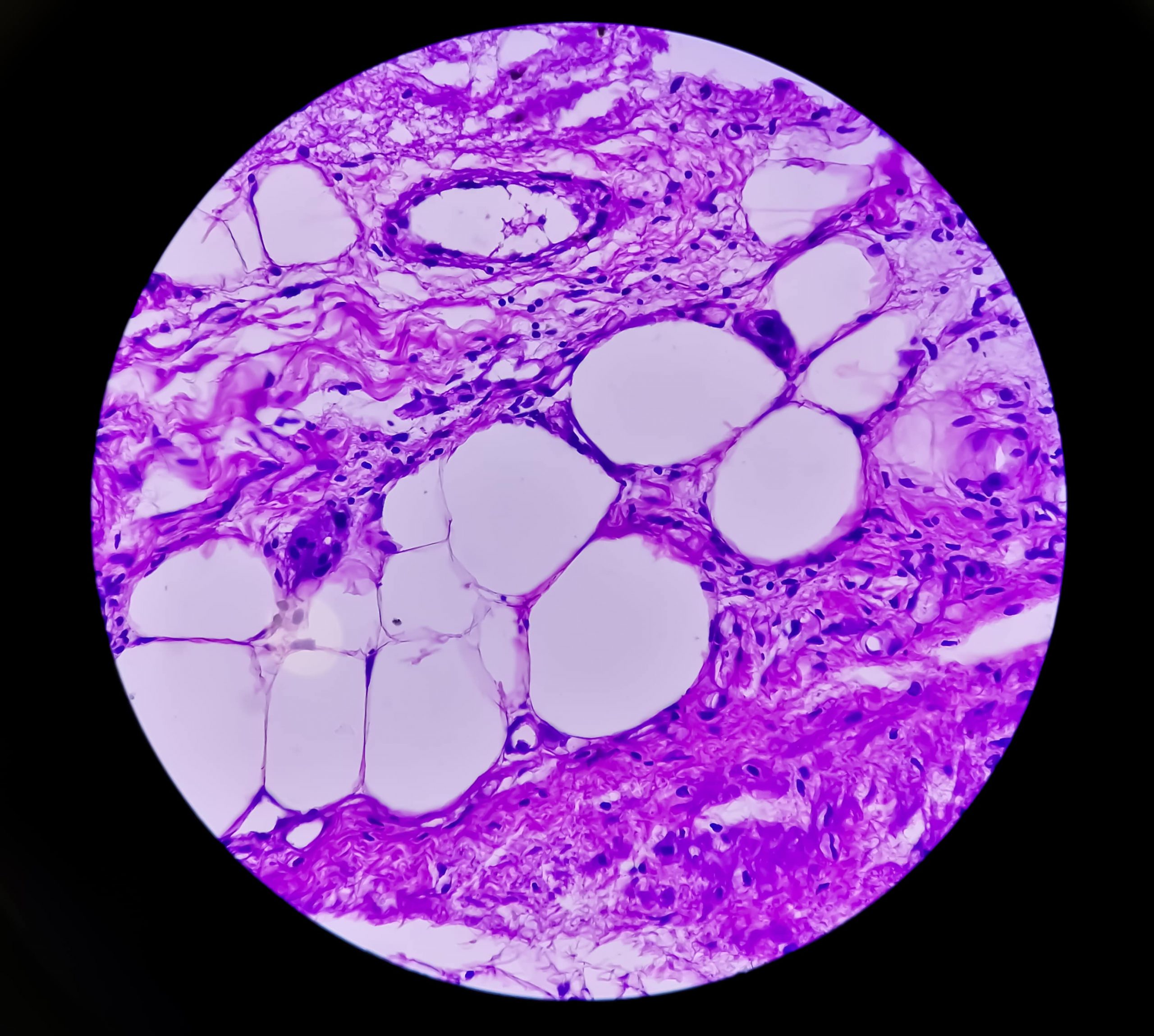 BPH - Benign Prostatic Hyperplasia | urology hospital