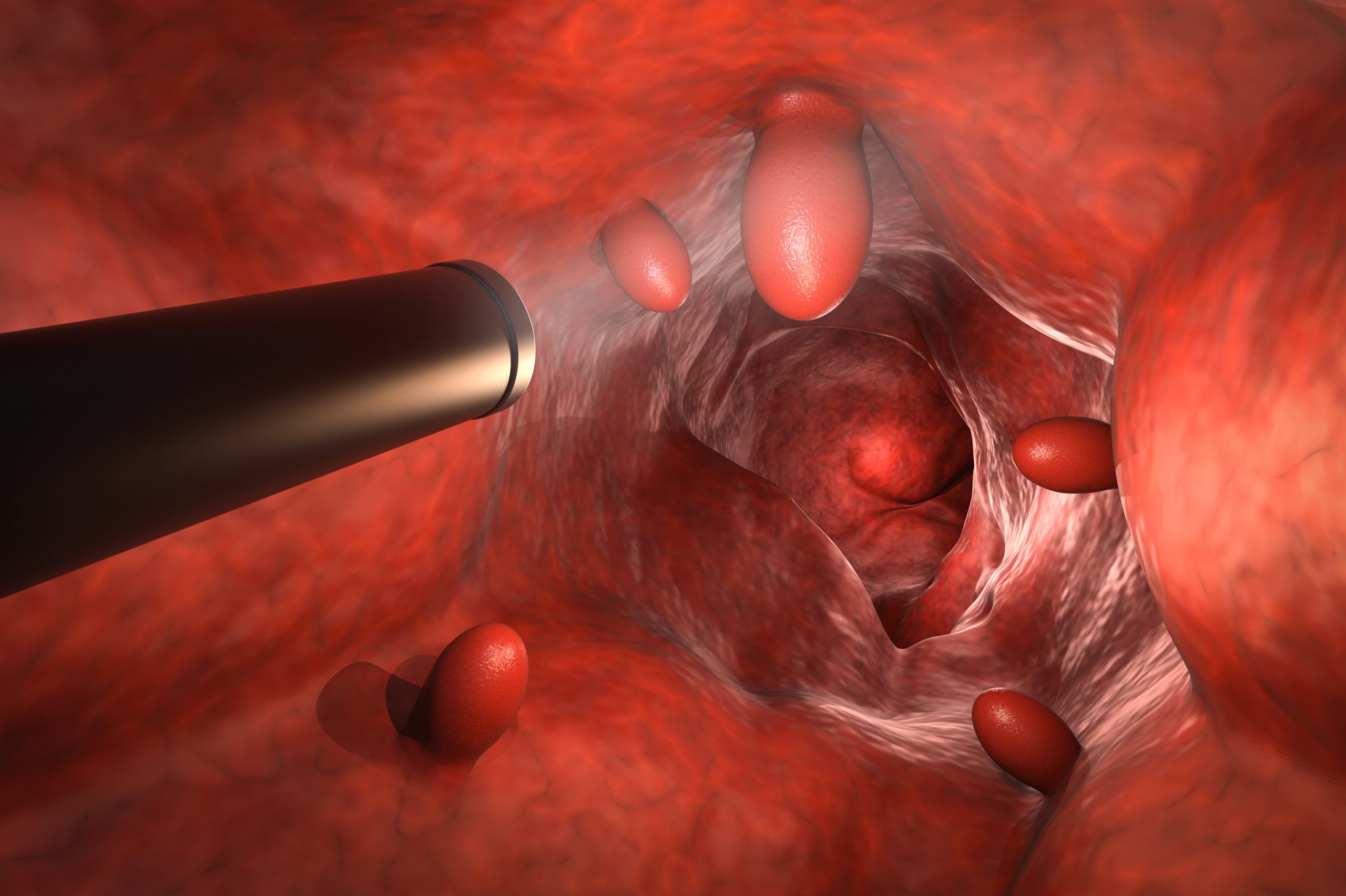 Endoscopic retrograde cholangiopancreatography