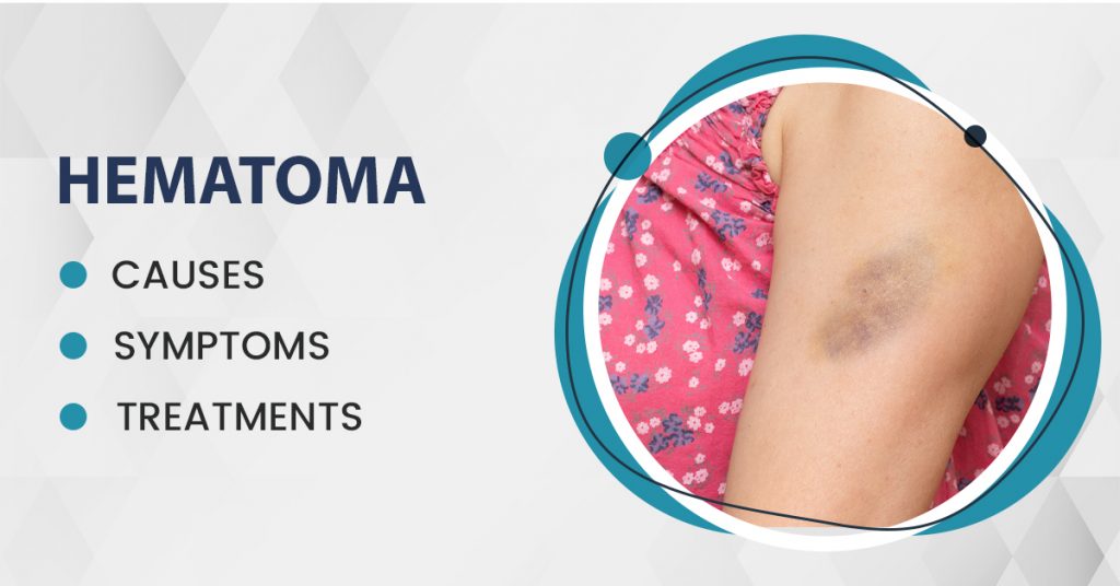 Hematoma- Causes, Symptoms, and Treatments