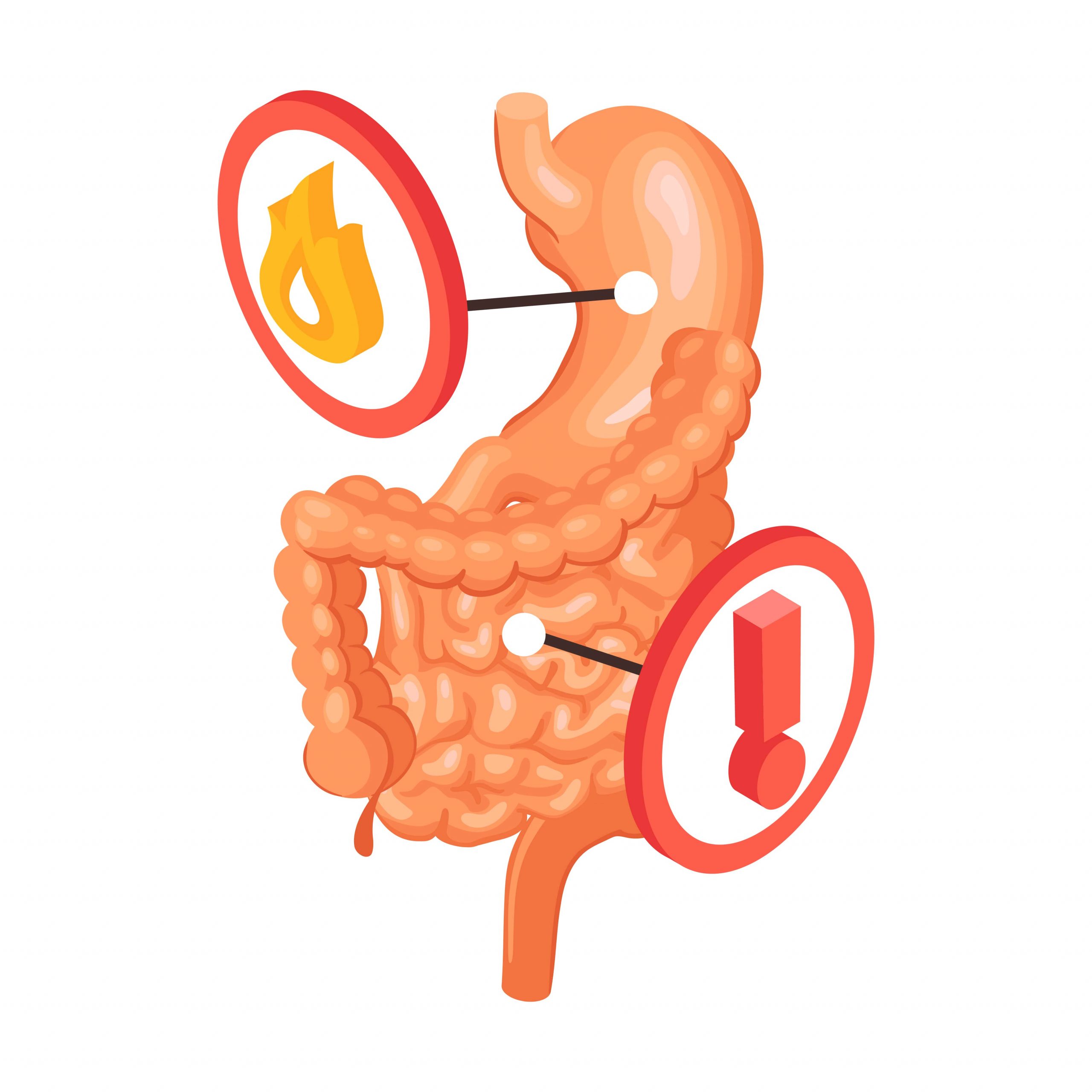 Percutaneous Nephrolithotomy