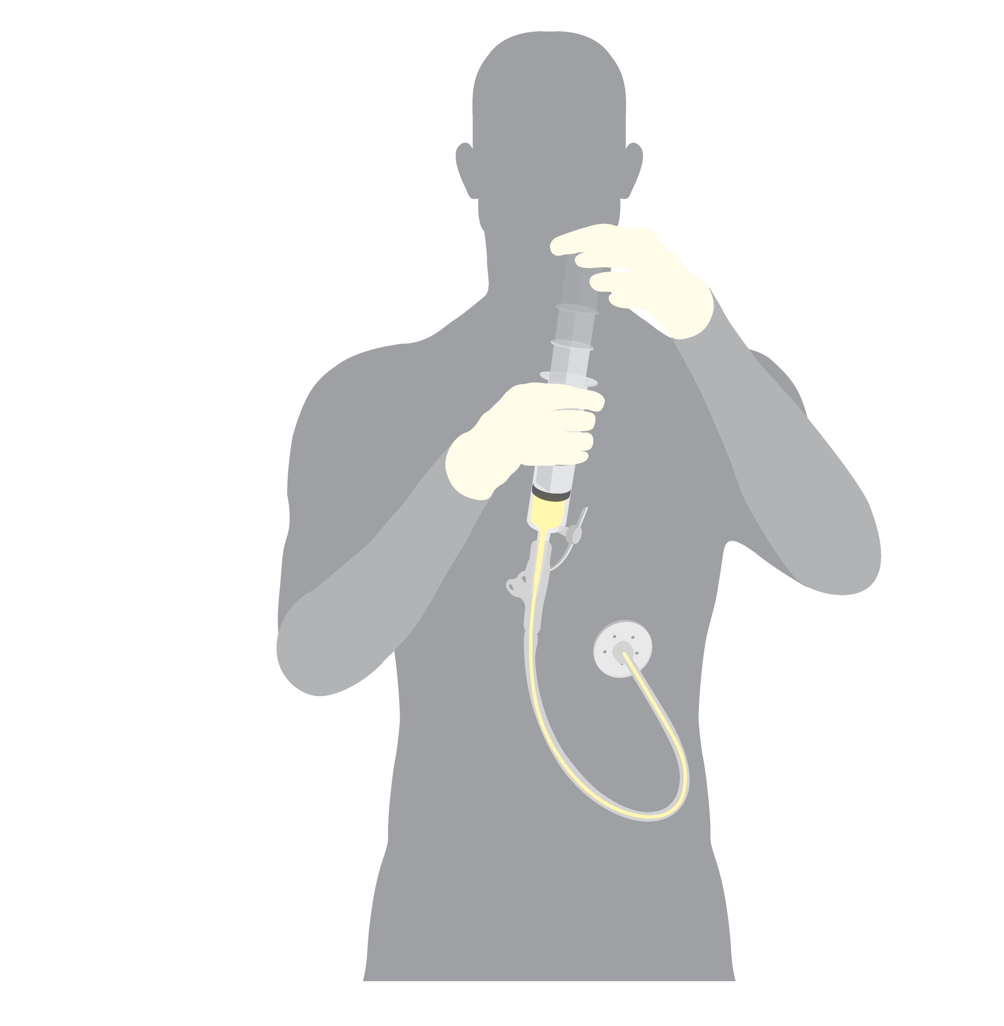 Percutaneous endoscopic gastrostomy