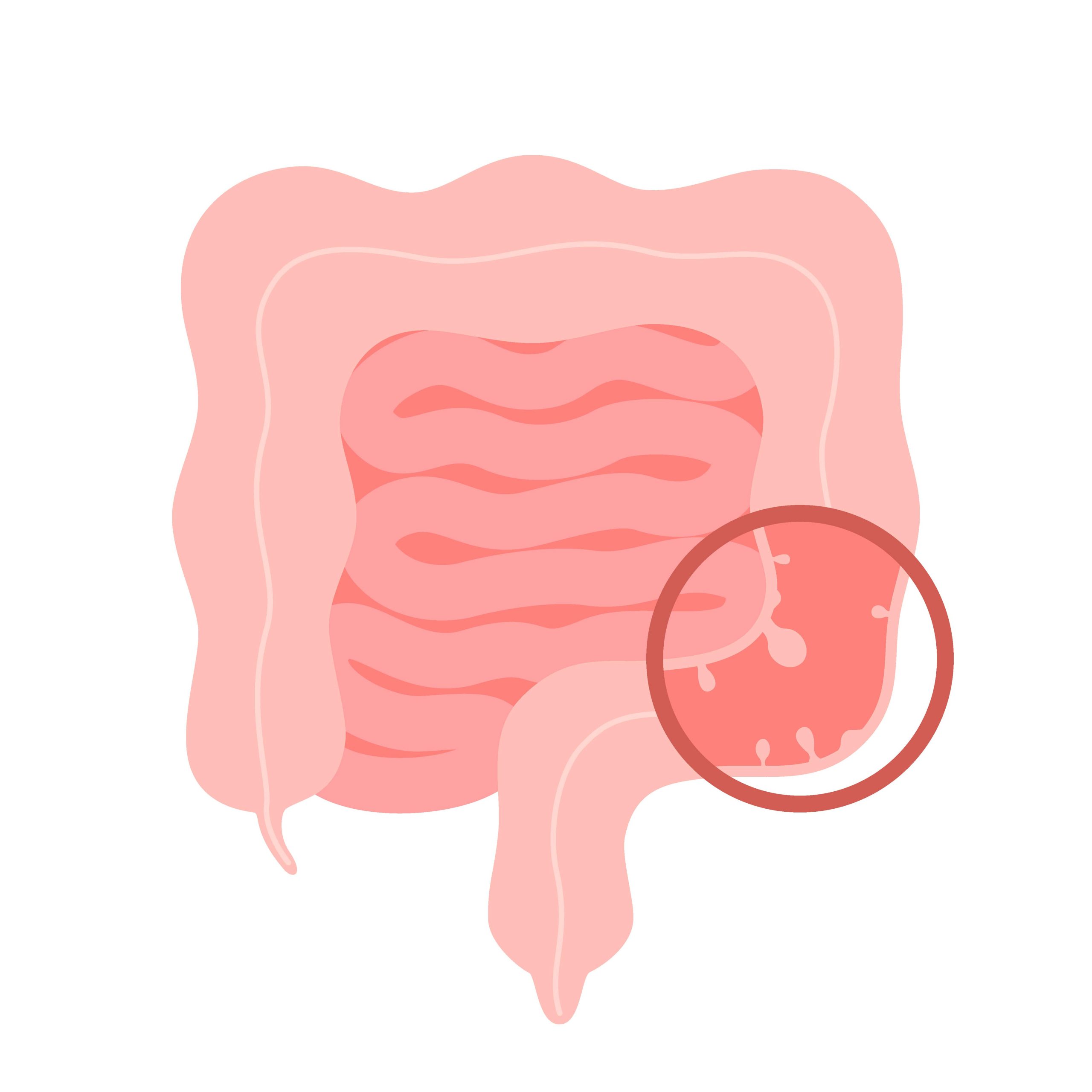 Polypectomy