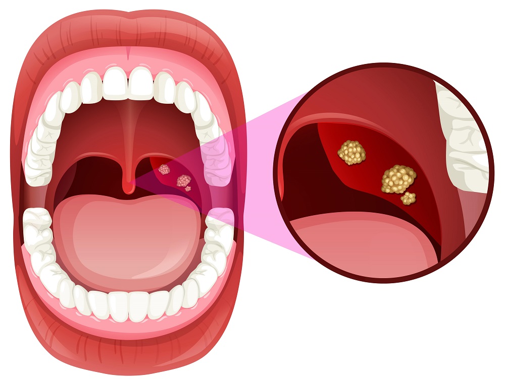 Tonsillectomy