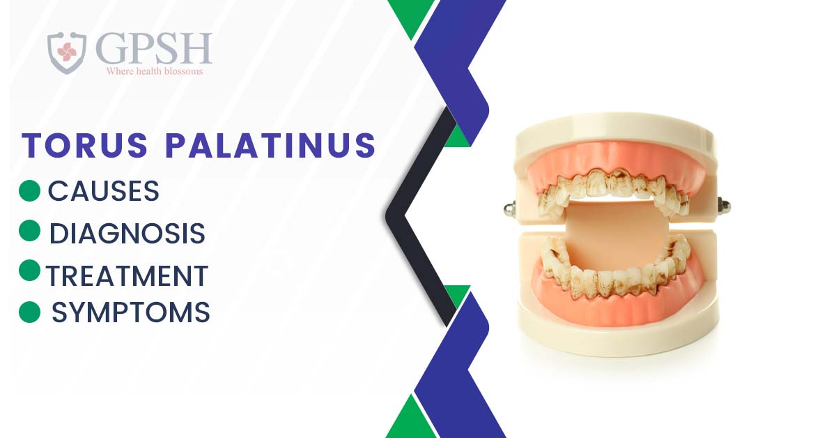 Torus Palatinus: Symptoms, Diagnosis, Causes, and Treatment