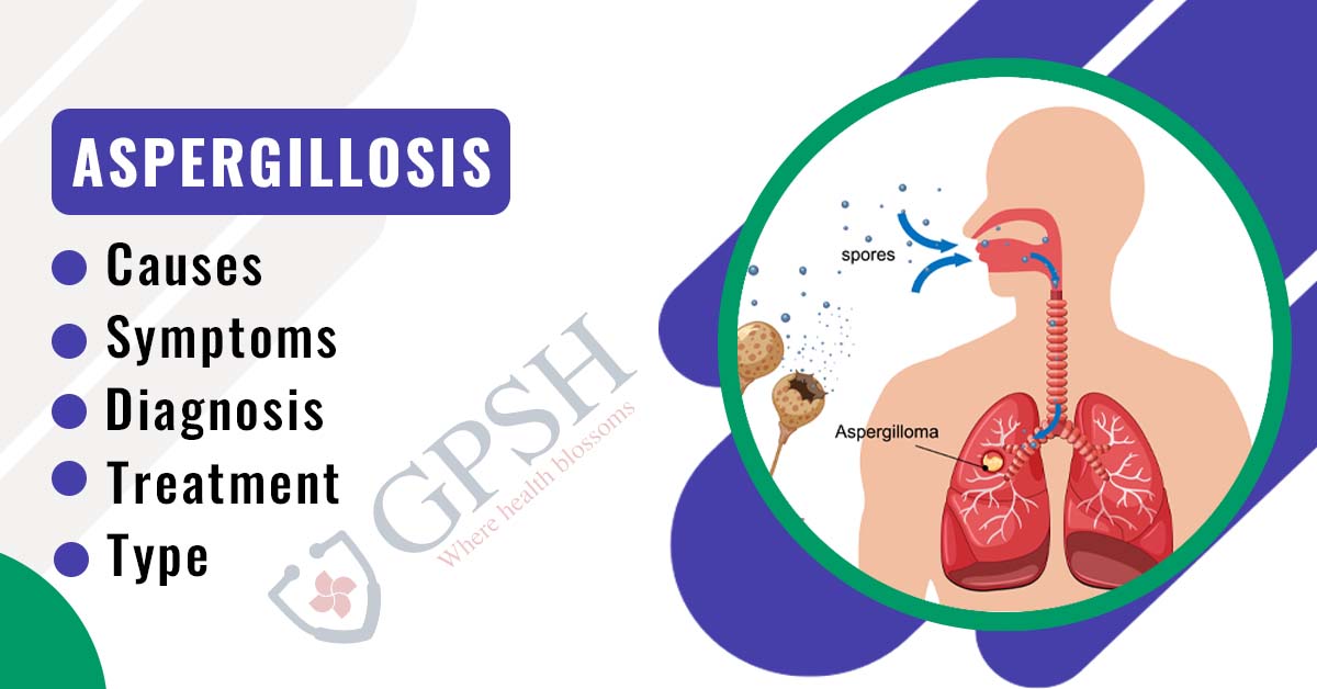 Aspergillosis: Types, Causes, Symptoms, Diagnosis & Treatment