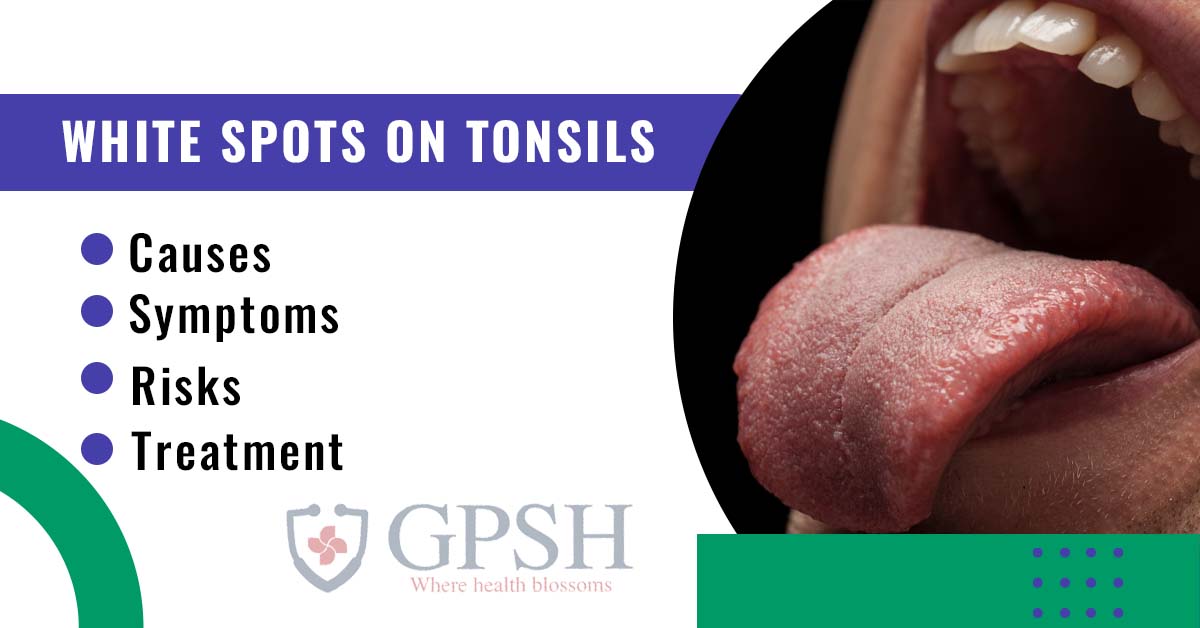 White Spots on Tonsils: Causes, Symptoms, Treatment, and Risks