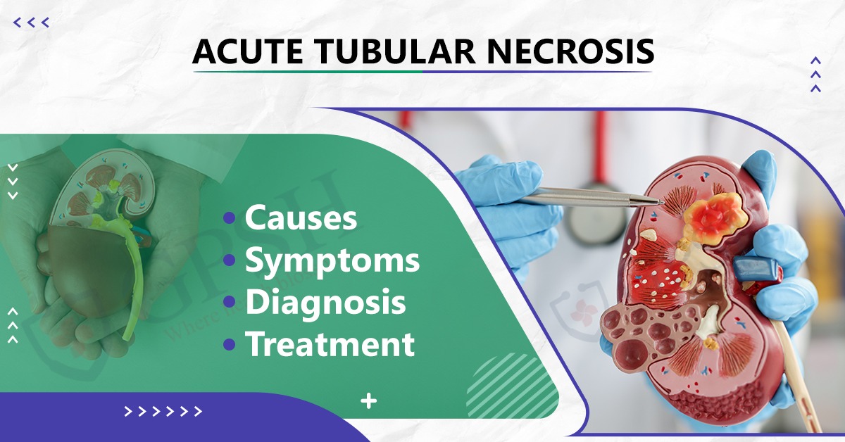 Acute Tubular Necrosis: Causes, Symptoms, Diagnosis, and Treatment