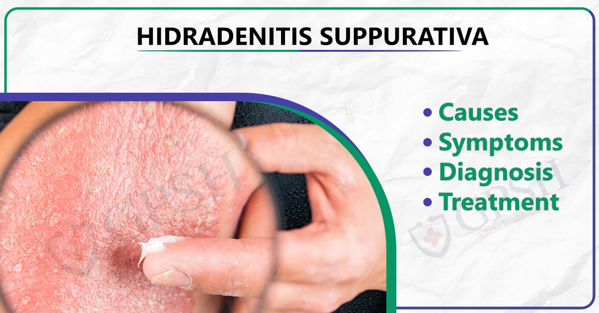 Hidradenitis Suppurativa: Causes, Symptoms, Diagnosis, and Treatment