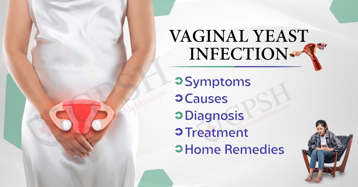 Vaginal Yeast Infection: Symptoms, Causes, Diagnosis, Treatment, and Home Remedies