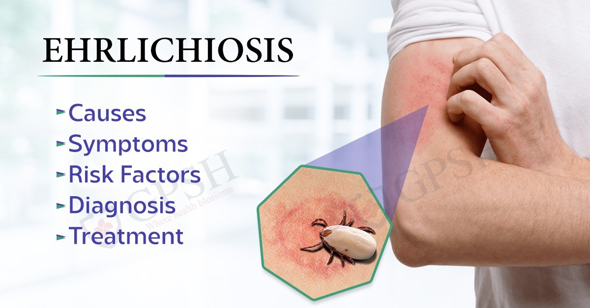 Ehrlichiosis: Causes, Symptoms, Risk Factors, Diagnosis and Treatment