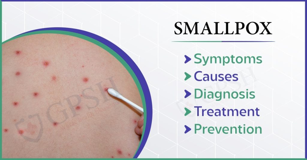 Smallpox