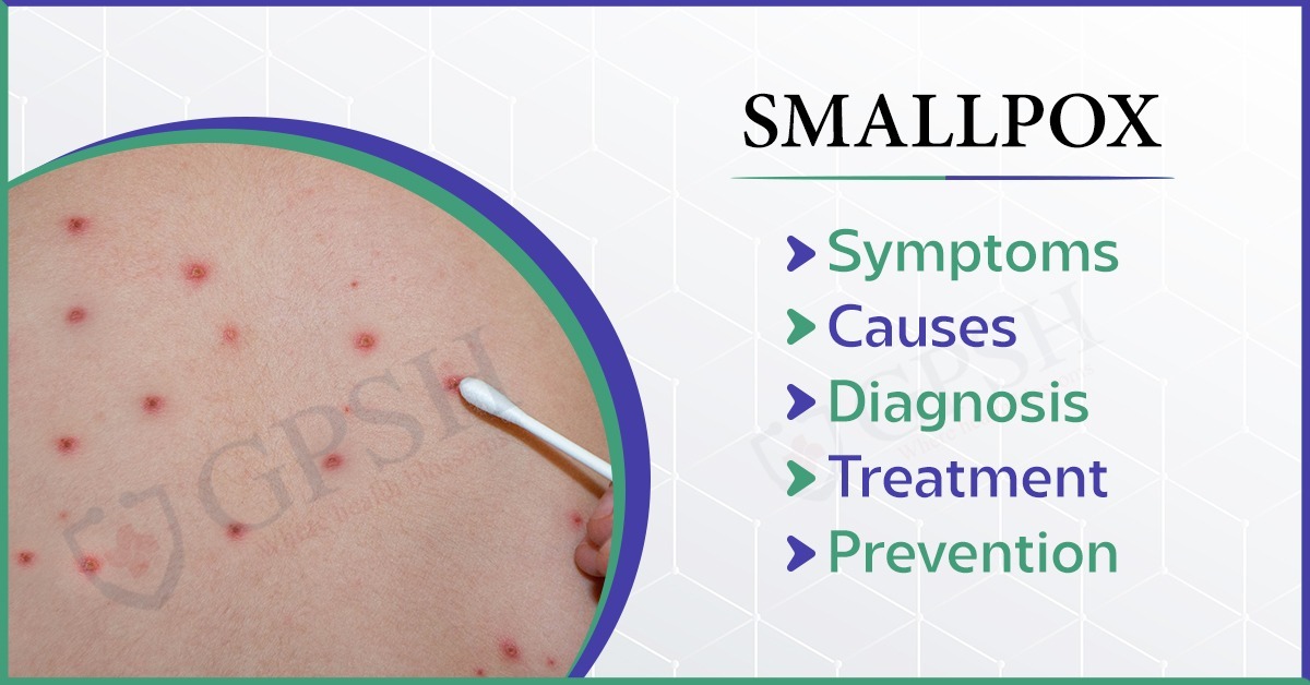 Smallpox: Symptoms, Causes, Diagnosis, Treatment, and Prevention