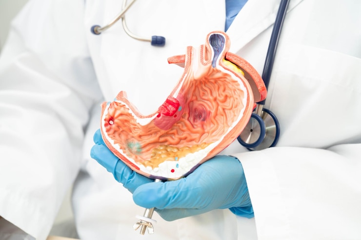 Lower GI Surgery