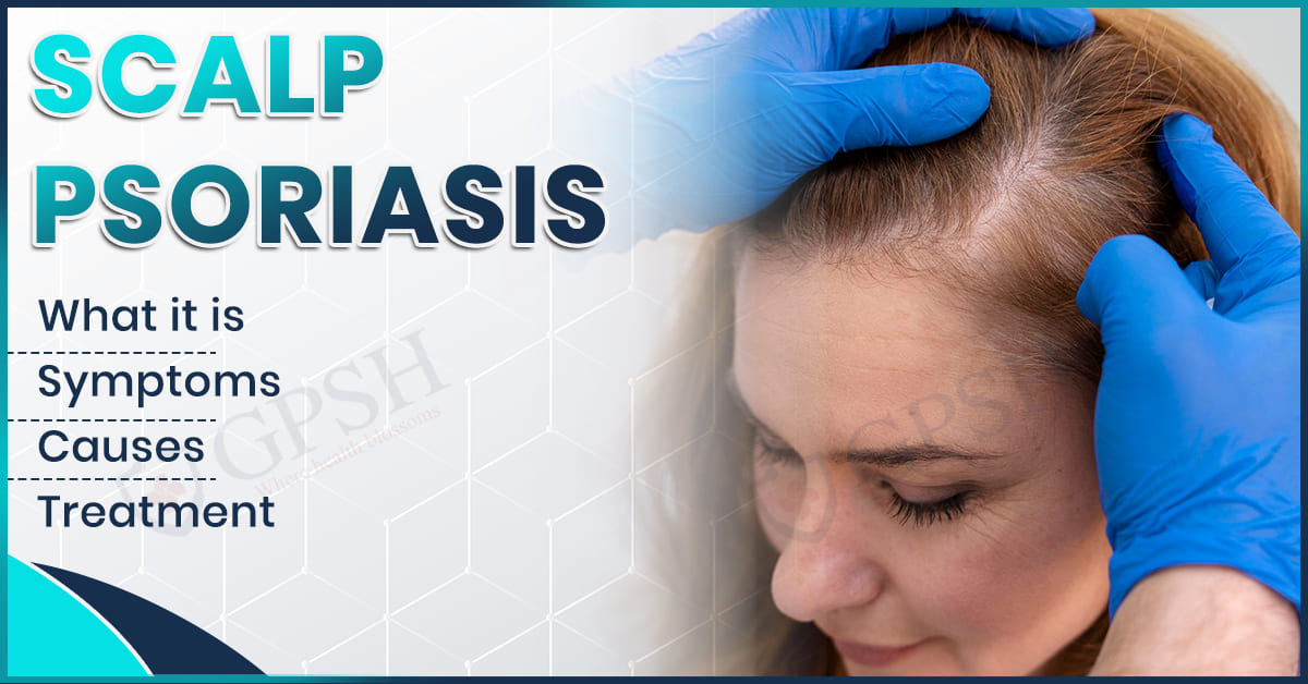 Scalp Psoriasis