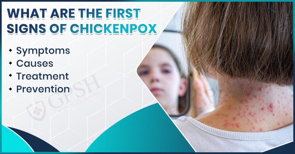 First Signs of Chickenpox